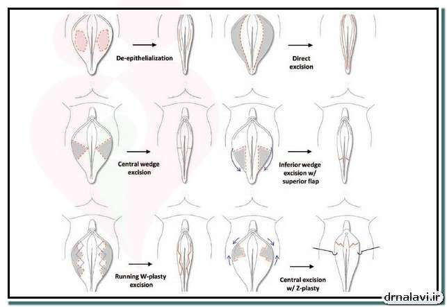 معرفی  و آشنایی با انواع جراحی‌های زیبایی واژن
