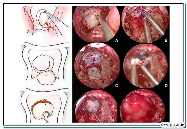 فرایند جراحی هیسترکتومی واژینال رادیکال