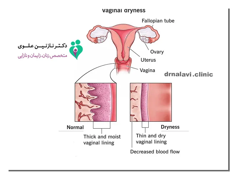 درمان خشکی واژن