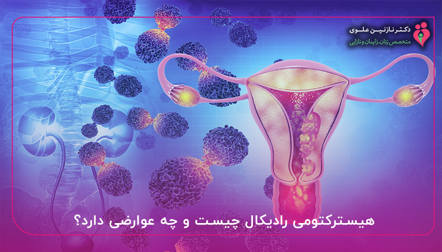 هیسترکتومی رادیکال چیست و چه عوارضی دارد؟