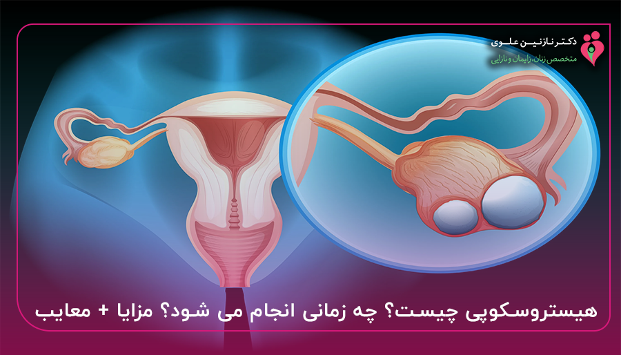 هیستروسکوپی چیست؟ چه زمانی انجام می شود؟ مزایا + معایب