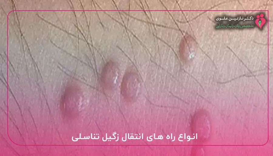 انواع راه های انتقال زگیل تناسلی