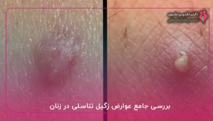 بررسی جامع عوارض زگیل تناسلی در زنان