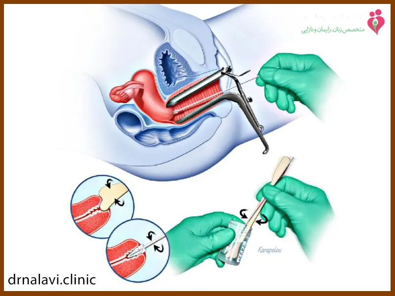 HPV مثبت اما پاپ‌اسمیر منفی!