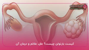 کیست بارتولن چیست؟ علل، علائم و درمان آن