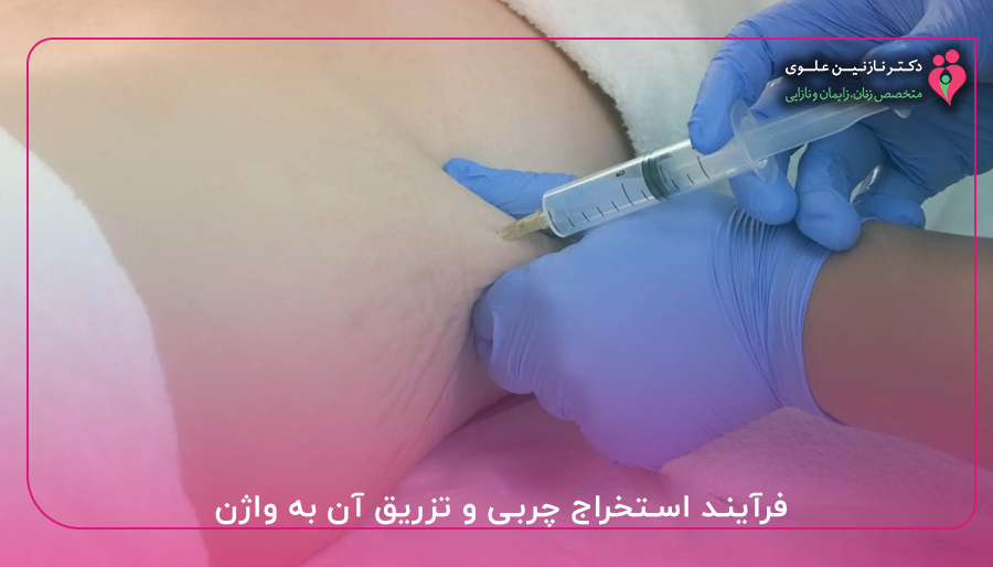 فرآیند استخراج چربی و تزریق آن به واژن