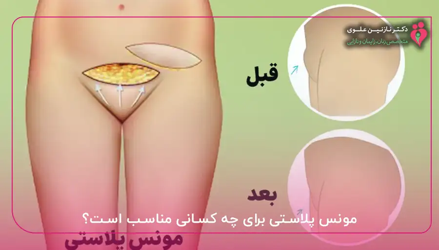 مونس پلاستی برای چه کسانی مناسب است؟