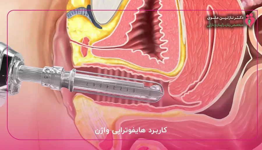 کاربرد هایفوتراپی واژن