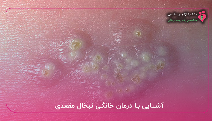 درمان خانگی تبخال مقعدی