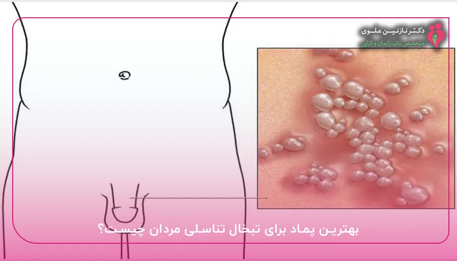 بهترین پماد برای تبخال تناسلی مردان چیست؟