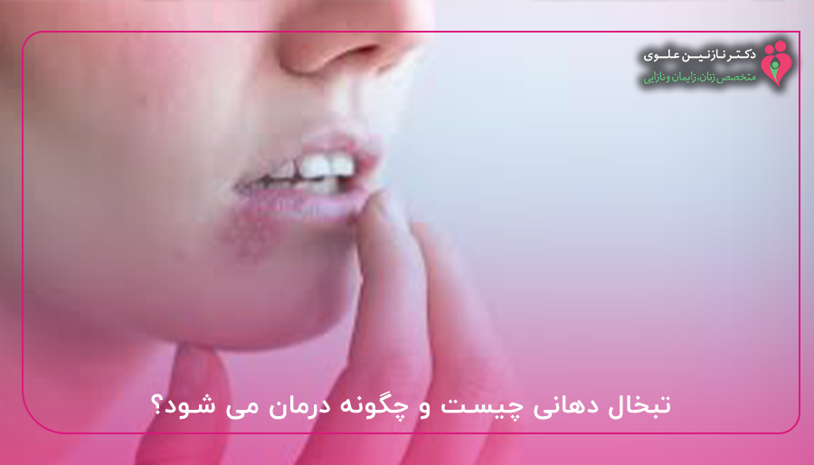 تبخال دهانی چیست و چگونه درمان می شود؟