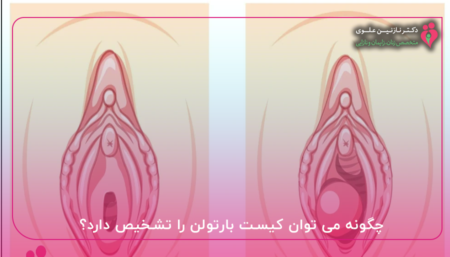 چگونه می توان کیست بارتولن را تشخیص دارد؟