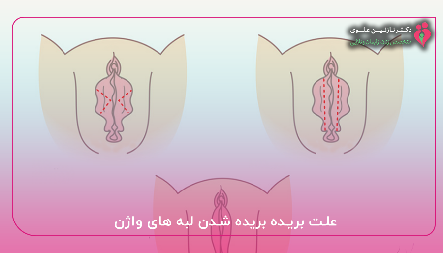 علت بریده بریده شدن لبه های واژن