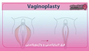 فرق لابیاپلاستی و واژینوپلاستی