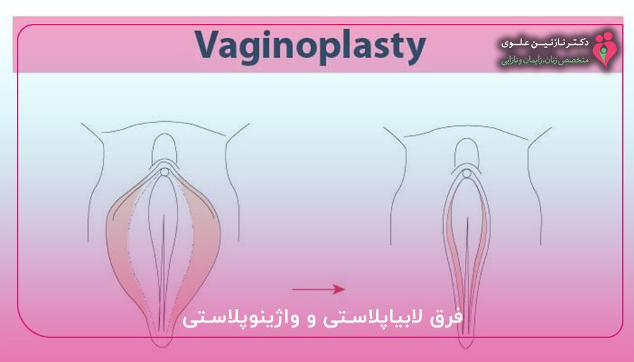 فرق لابیاپلاستی و واژینوپلاستی
