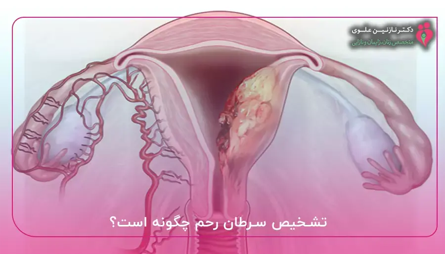 تشخیص سرطان رحم