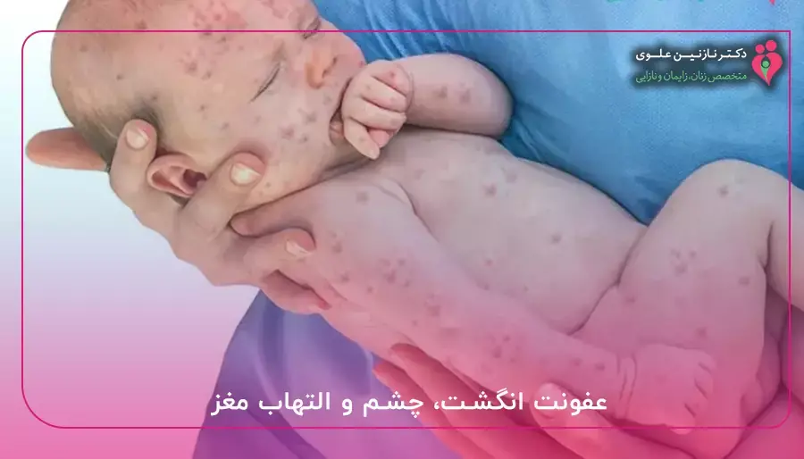 عفونت انگشت، چشم و التهاب مغز