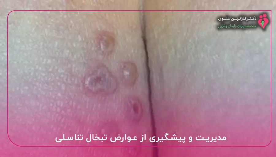 مدیریت و پیشگیری از عوارض تبخال تناسلی