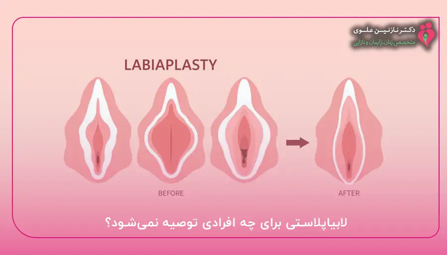 لابیاپلاستی برای چه افرادی توصیه نمی‌شود؟