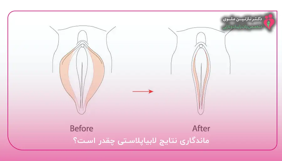 ماندگاری نتایج لابیاپلاستی چقدر است؟