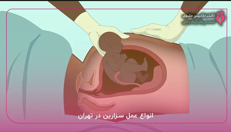 انواع عمل سزارین در تهران