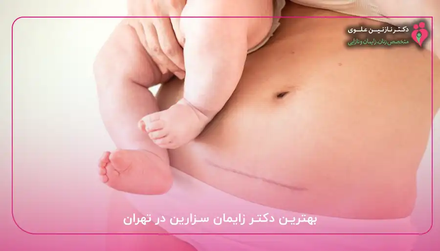 بهترین دکتر زایمان سزارین در تهران