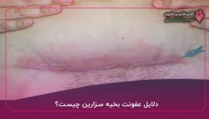 دلایل عفونت بخیه سزارین چیست؟