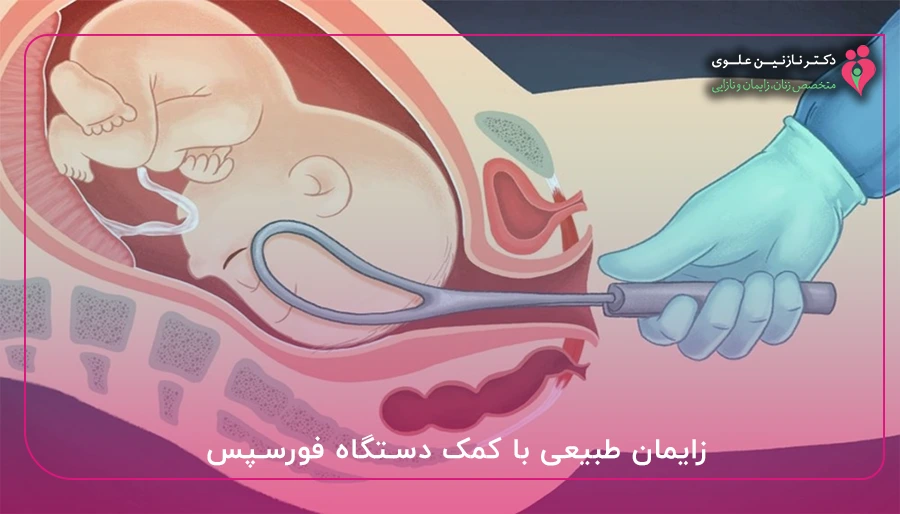 زایمان طبیعی با کمک دستگاه فورسپس