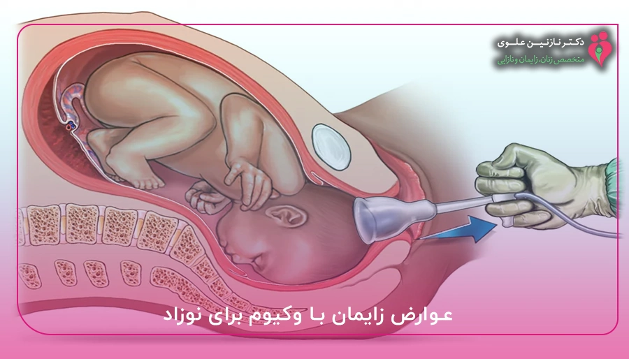 عوارض زایمان با وکیوم برای نوزاد