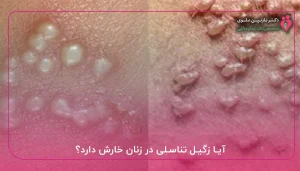 آیا زگیل تناسلی در زنان خارش دارد؟