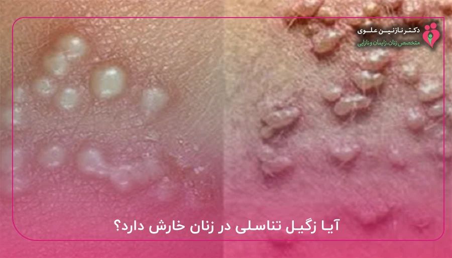 آیا زگیل تناسلی در زنان خارش دارد؟