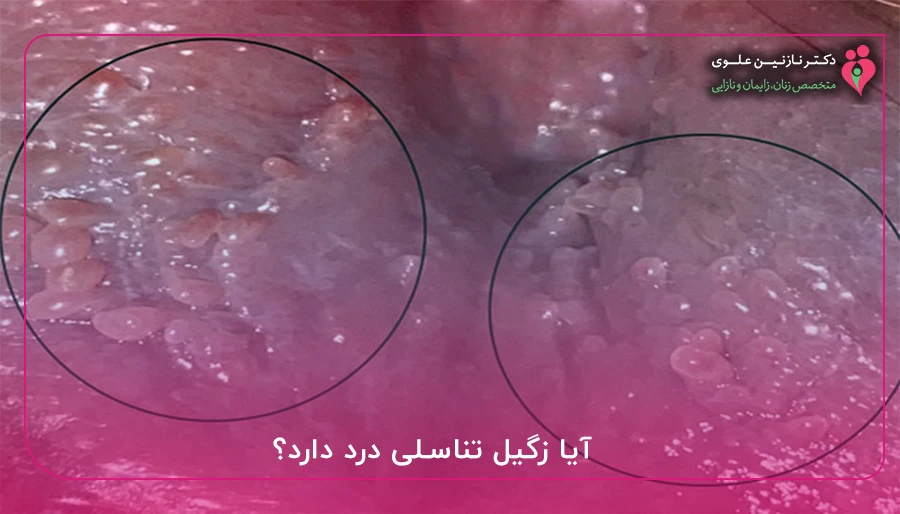 آیا زگیل تناسلی درد دارد؟