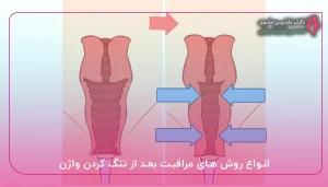 انواع روش های مراقبت بعد از تنگ کردن واژن