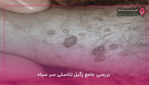 بررسی جامع زگیل تناسلی سر سیاه