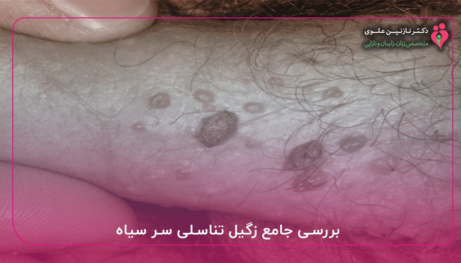 بررسی جامع زگیل تناسلی سر سیاه