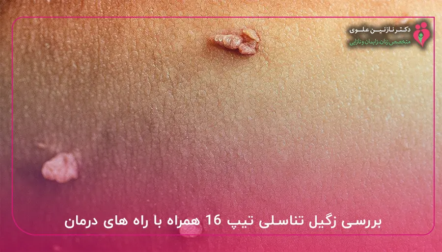 بررسی زگیل تناسلی تیپ ۱۶ با راه های درمان