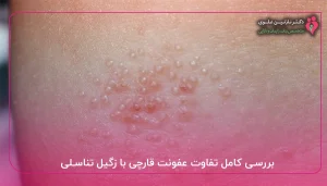 بررسی کامل تفاوت عفونت قارچی با زگیل تناسلی