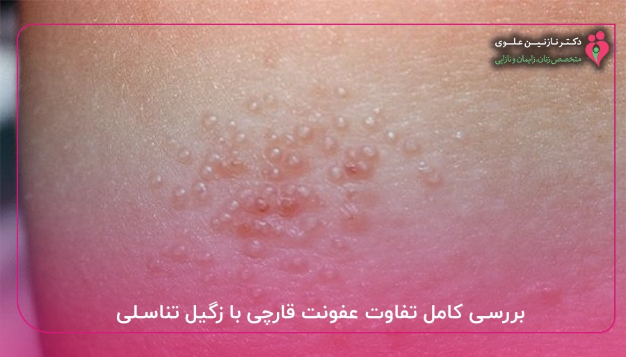 بررسی کامل تفاوت عفونت قارچی با زگیل تناسلی