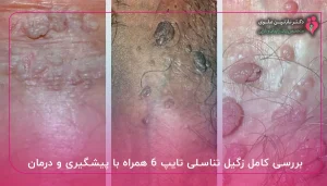 بررسی کامل زگیل تناسلی تایپ ۶ همراه با پیشگیری و درمان