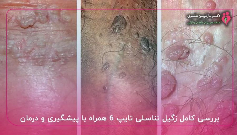 بررسی کامل زگیل تناسلی تایپ ۶ همراه با پیشگیری و درمان
