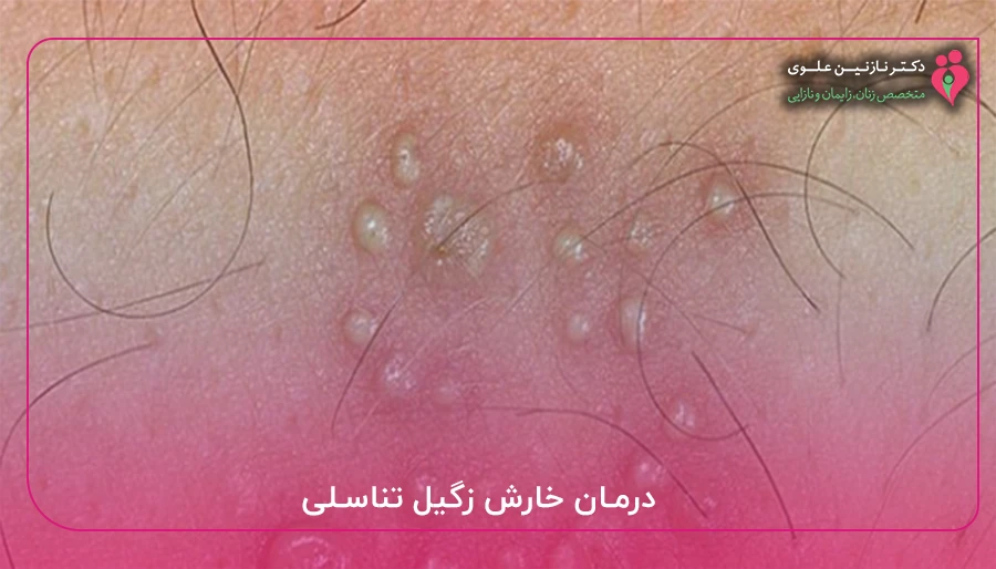 درمان خارش زگیل تناسلی