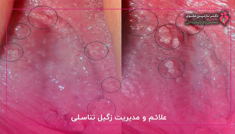 علائم و مدیریت زگیل تناسلی