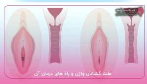 علت گشادی واژن و راه های درمان آن