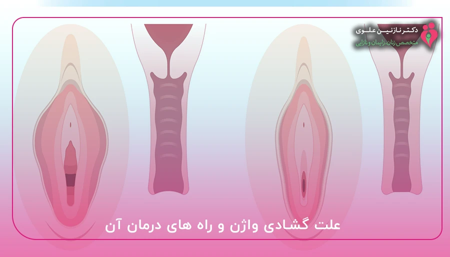 علت گشادی واژن و راه های درمان آن