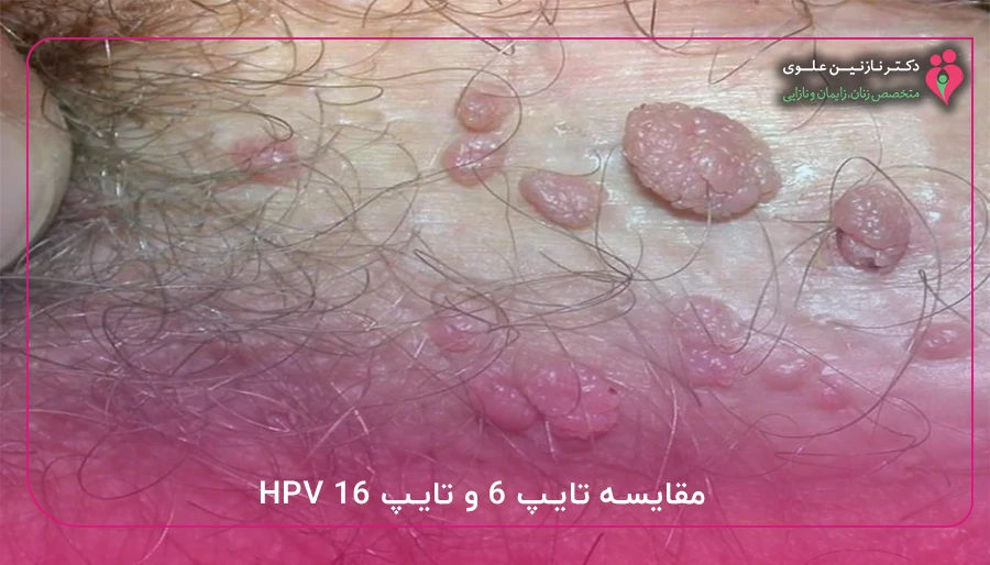 مقایسه تایپ ۶ و تایپ ۱۶ HPV