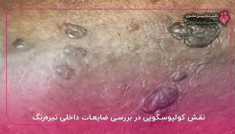 نقش کولپوسکوپی در بررسی ضایعات داخلی تیره_رنگ