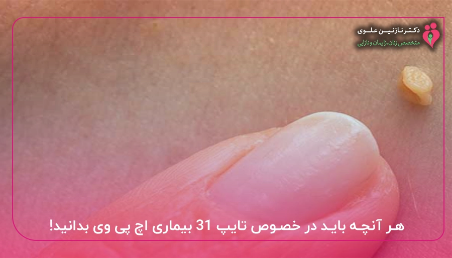 هر آنچه باید در خصوص تایپ ۳۱ بیماری اچ پی وی بدانید!