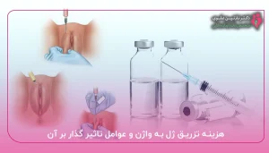 هزینه تزریق ژل به واژن و عوامل تاثیر گذار بر آن